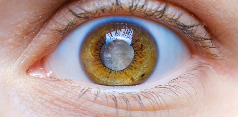 What are cataracts?