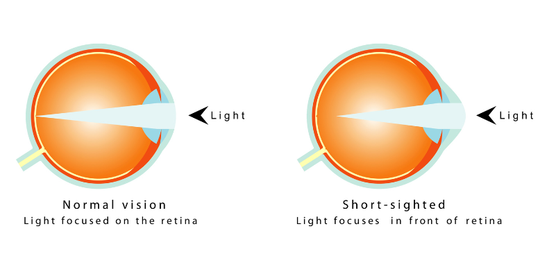 Nearsightedness